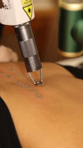 Remoção de Tatuagem